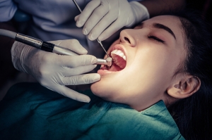 Alternatives to Root Canal Treatment: Exploring Other Options
